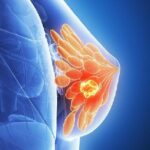 Researchers Uncover Cancer Dormancy Hint at New Treatments 